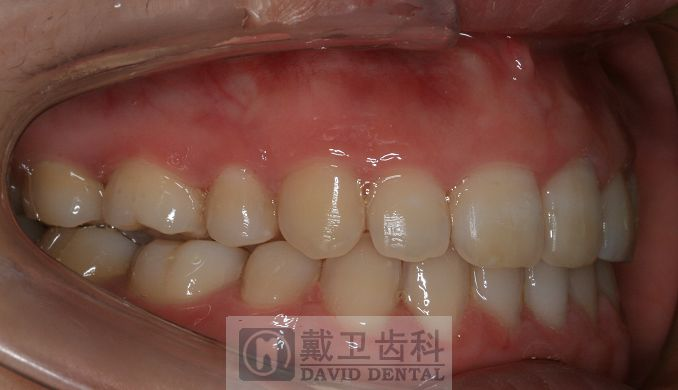 牙齿矫正患者4