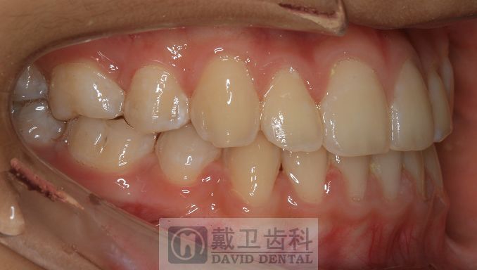 牙齿矫正患者3