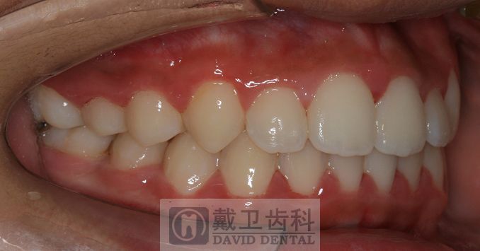 牙齿矫正患者1