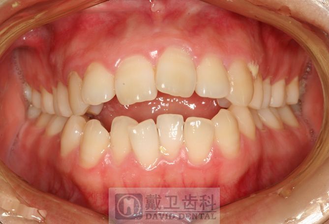 牙齿矫正患者4